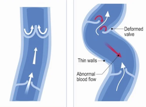 varicose veins schematic