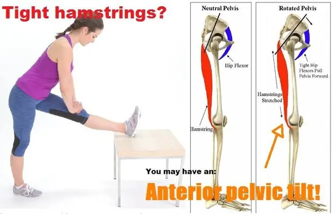 tight hip=flexor muscles cause Achilles tendonitis