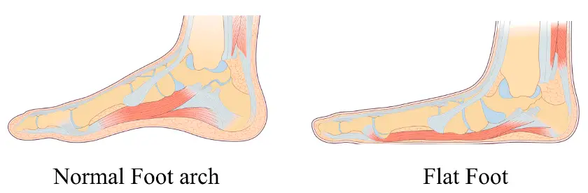 difference between neutral arch foot and flat foot